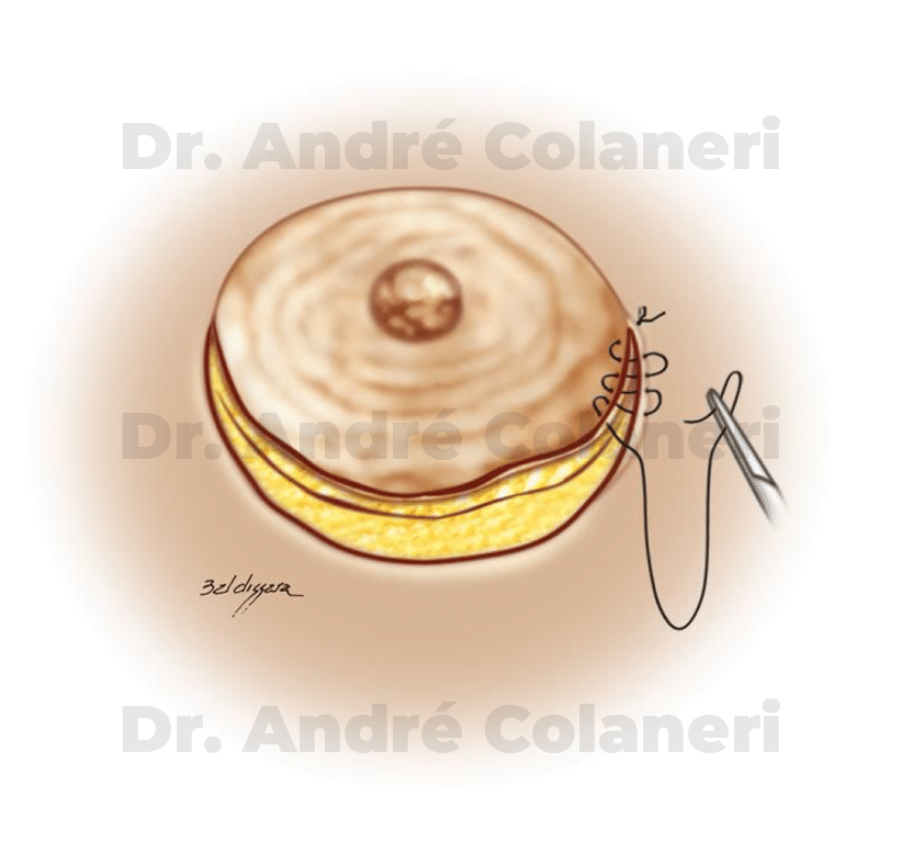 Sutura da incisão periareolar inferior