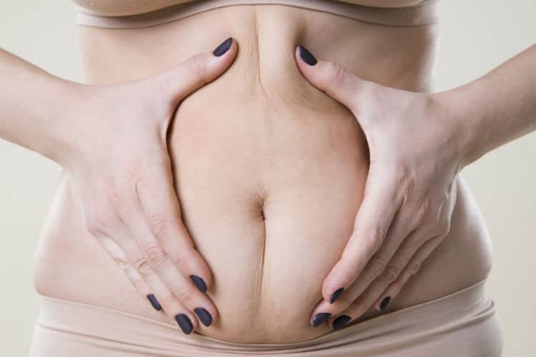 abdominoplastia-antes-y-después-2 