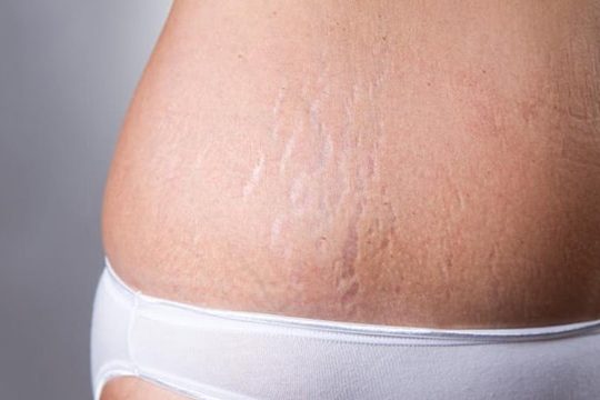 Estrias: como corrigi-las?