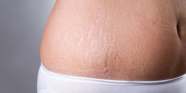 estrias-como-corrigir Estrias: como corrigi-las?