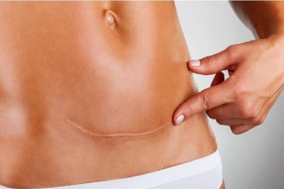 Fibrose na cirurgia plástica: como minimizar o risco