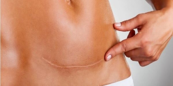 Fibrose na cirurgia plástica: como minimizar o risco