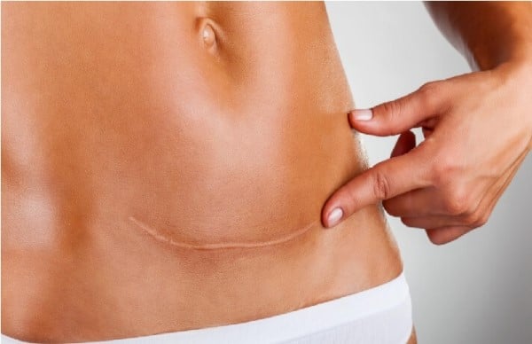 fibrose-cirurgia-plastica-como-minimizar-risco-img-1 Fibrose na cirurgia plástica: como minimizar o risco