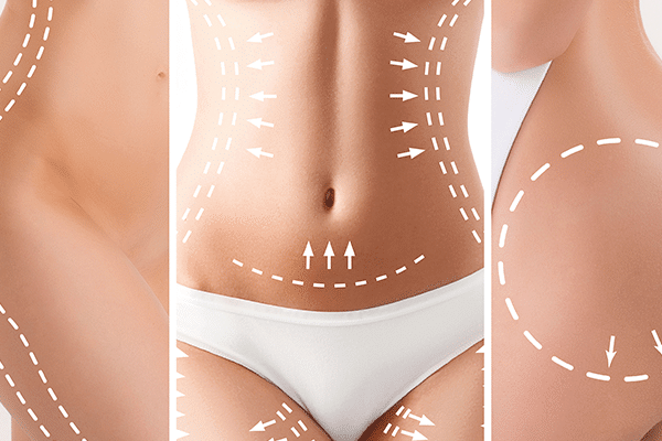 vibrolipo o que e como funciona img 1